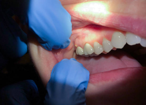 Best Emergency Wisdom Teeth Removal in King City, OR