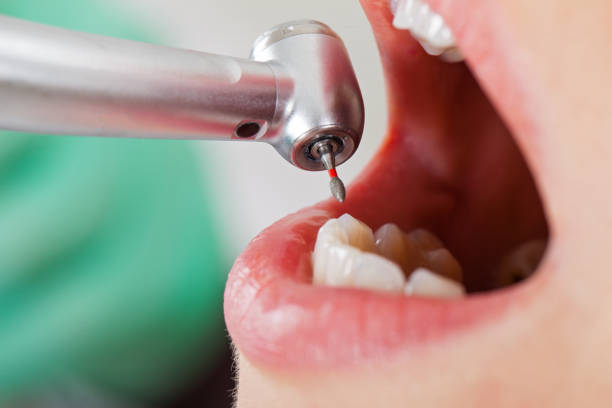 Best Emergency Tooth Extraction in King City, OR